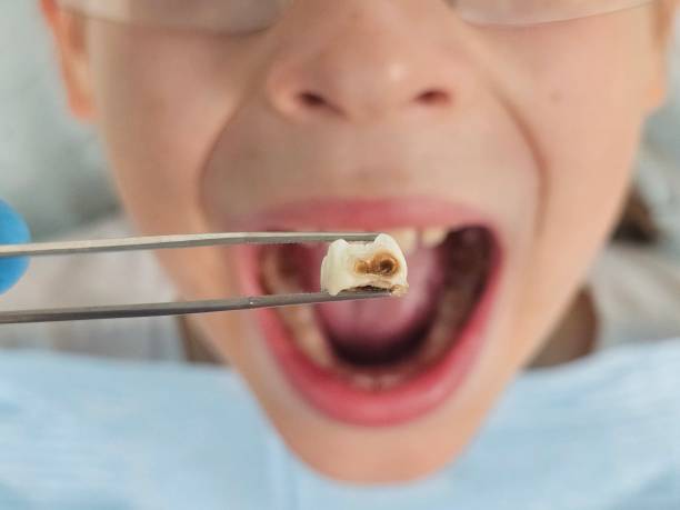 Best Emergency Dentist for Lost Fillings or Crowns in West Baraboo, WI